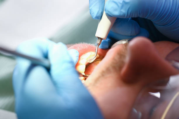 Best Emergency Root Canal Therapy in Georgetown, IN